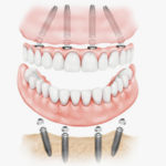 Технология имплантации зубов all‐on‐4
